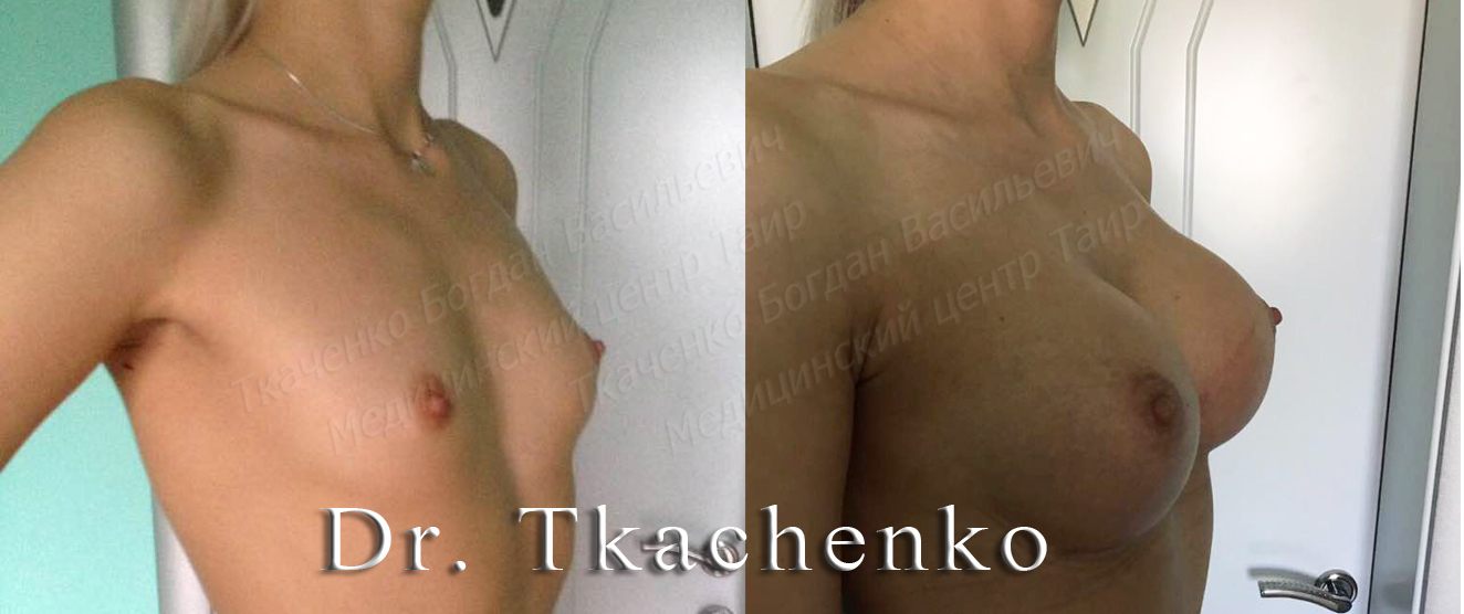 Мармеладная-грудь-фото-до-и-после-увеличение-груди-1 (2)