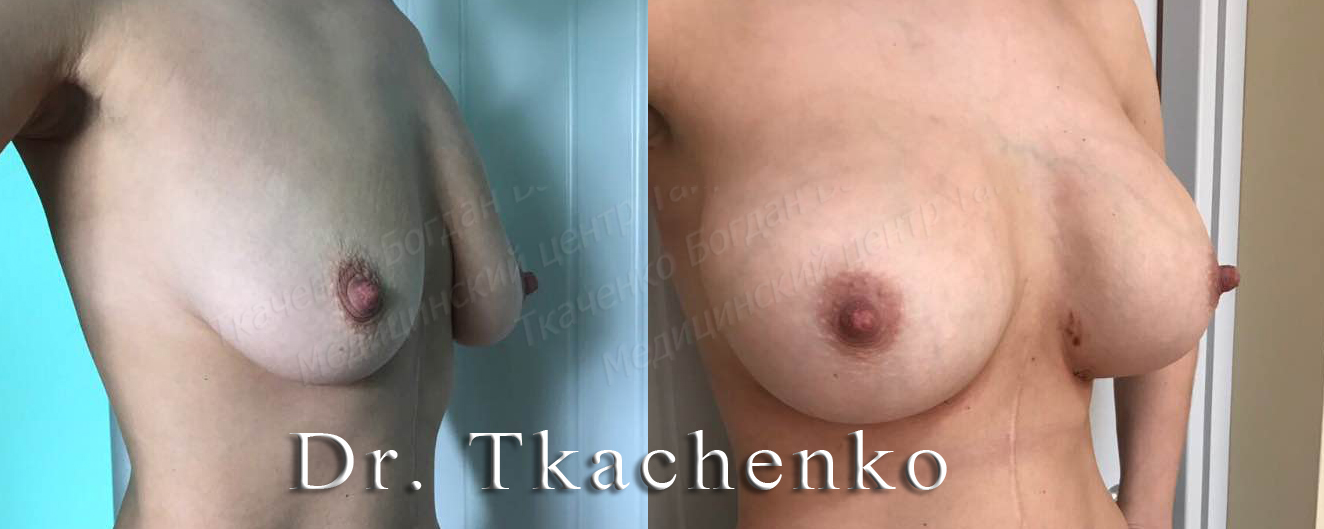 Мармеладная-грудь-фото-до-и-после-увеличение-груди-1
