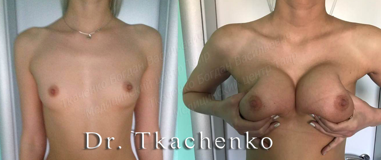 Мармеладная-грудь-фото-до-и-после-увеличение-груди-2 (1)