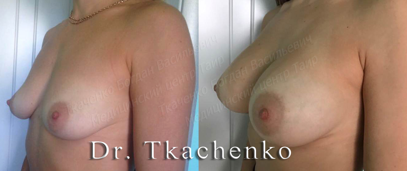 Мармеладная-грудь-фото-до-и-после-увеличение-груди-3