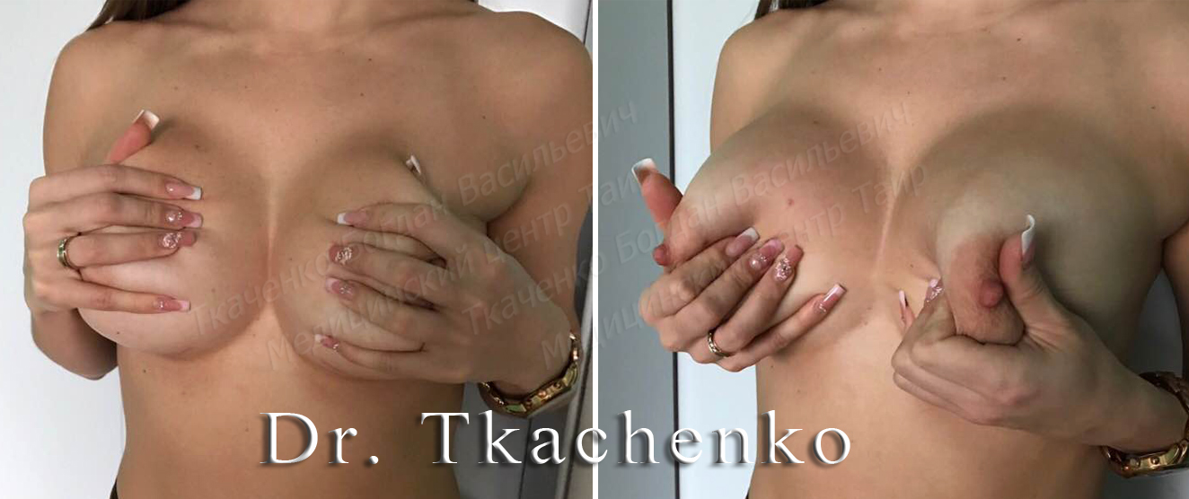 Мармеладная-грудь-фото-до-и-после-увеличение-груди-5