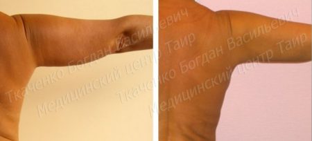 фото-до-и-после_подтяжка-кожи-рук